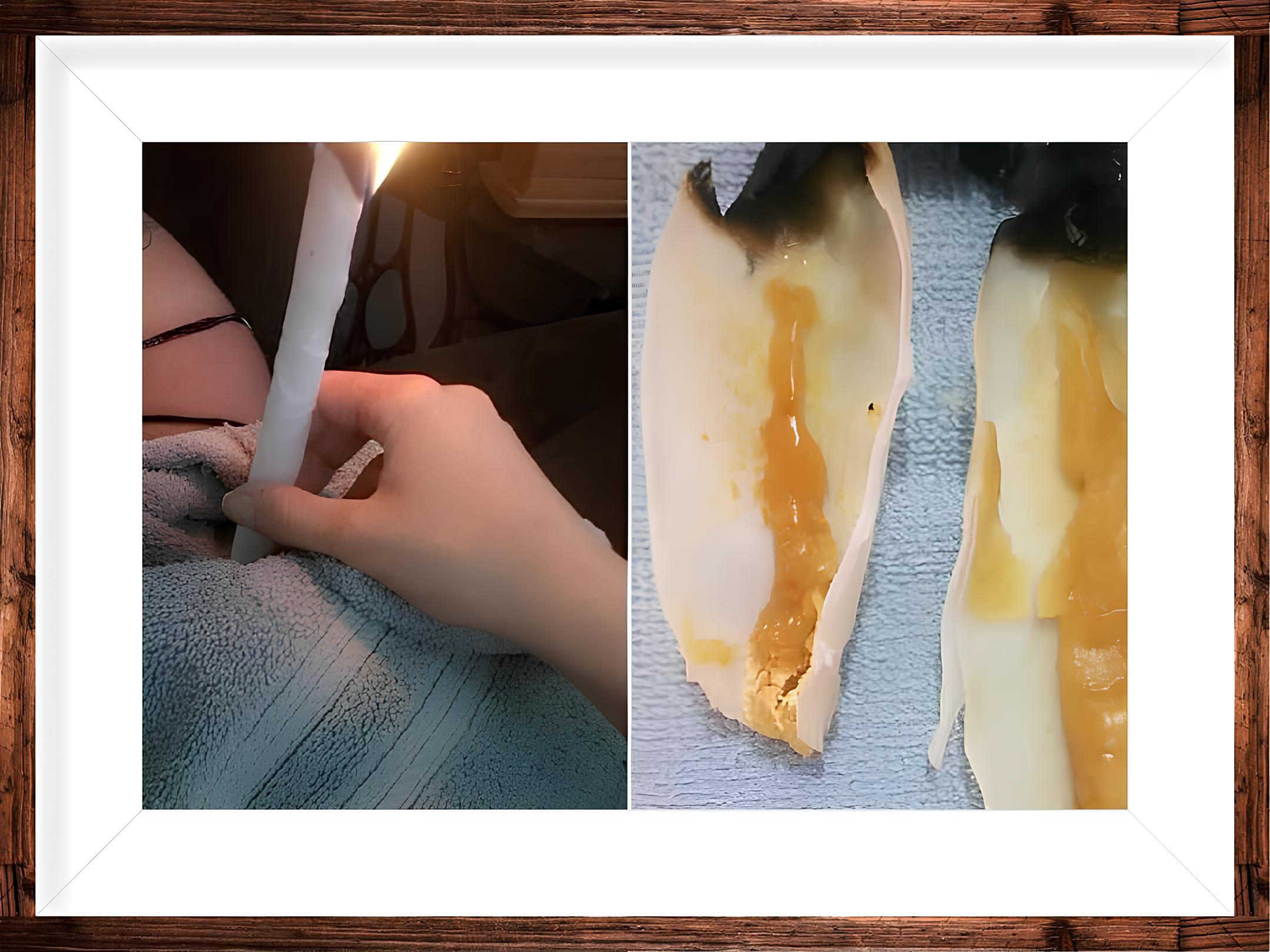 Cone Chinês para limpeza dos ouvidos – Fabricação e Venda - Foto 2